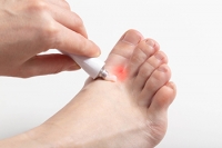 What Is Athlete’s Foot and How Can You Contract It?