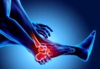 Types of Arthritis That Can Develop in the Feet
