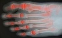 Early Indicators of Foot Arthritis