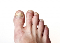 How to Recognize a Fungal Infection of the Toes
