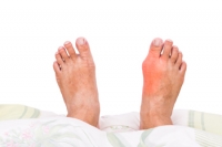 How Is Gout Diagnosed?