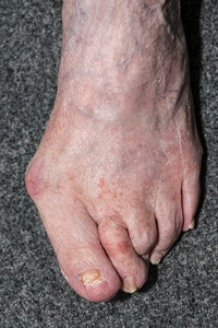 What Is a Bunion?